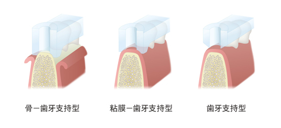 ガイド支持様式