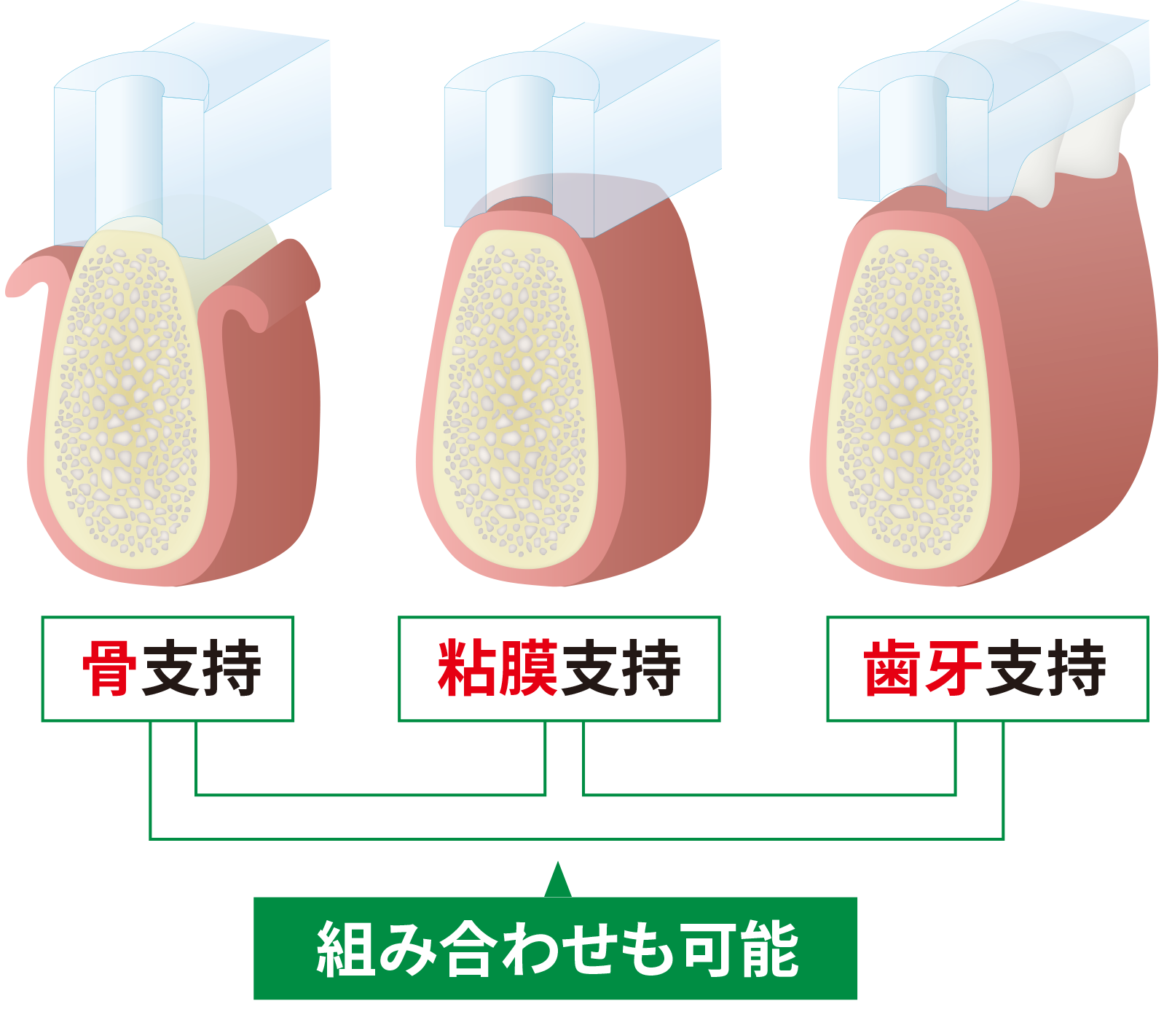 組み合わせ可能