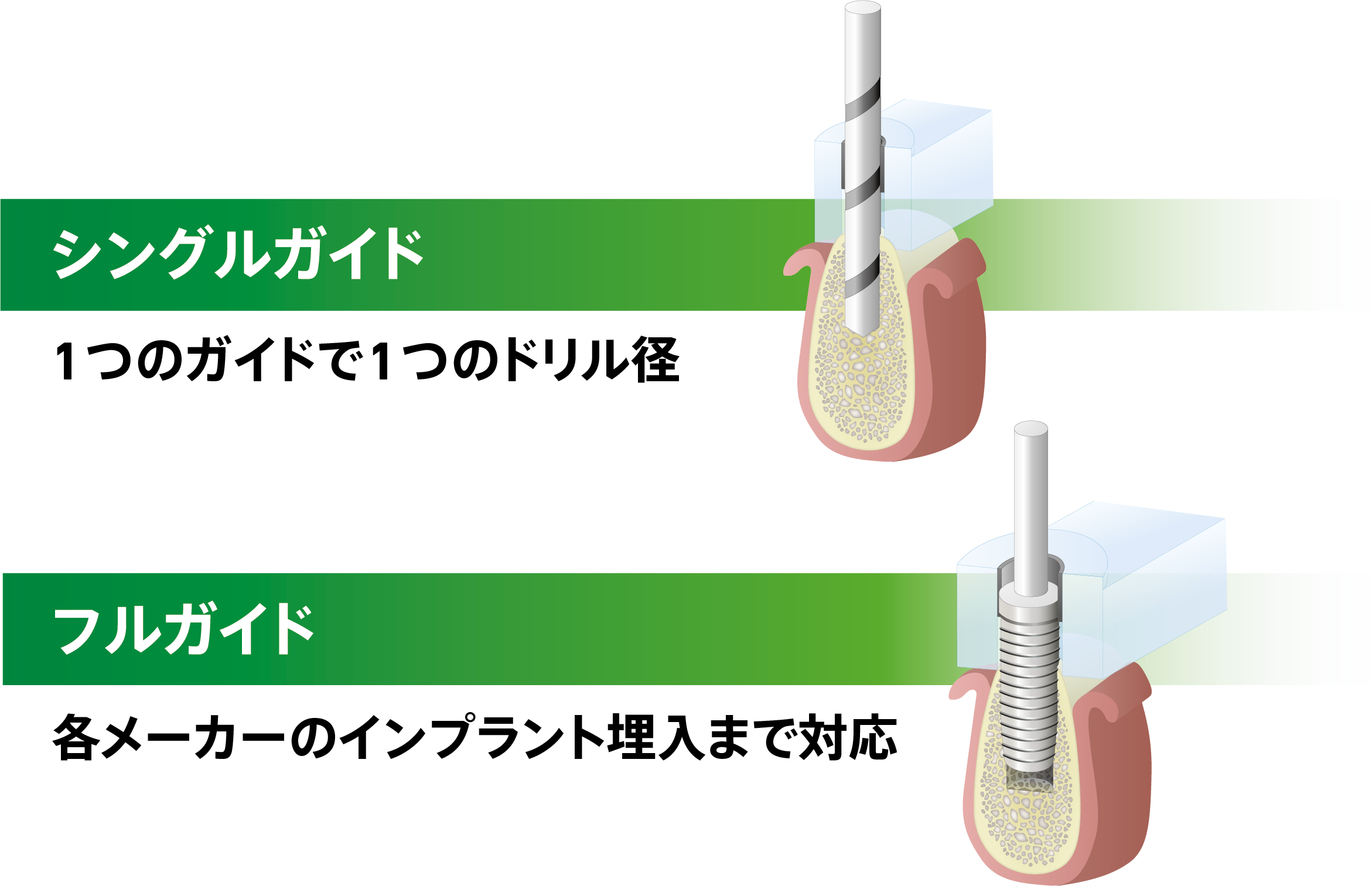 シングルガイドとフルガイド