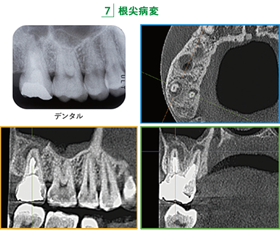 7 根尖病変