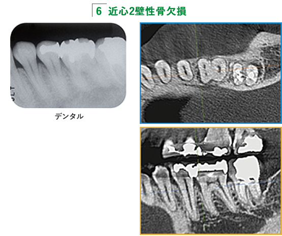 6 近心2壁性骨欠損