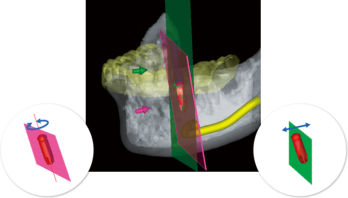 Implant cross-section