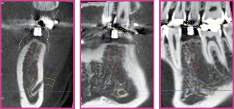 Implant cross-section