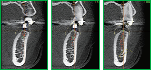 Conventional cross section perpendicular to the dental arch