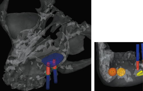 Bone Graft Simulation