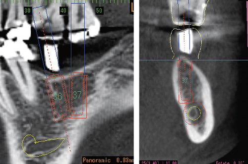 Mandibular canal marking