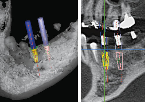 Parallel implantation