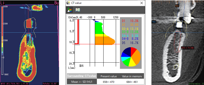 Bone quality diagnosis with CT value color display or CT value measurement.