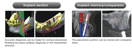 Implant section/Implant memory/comparison