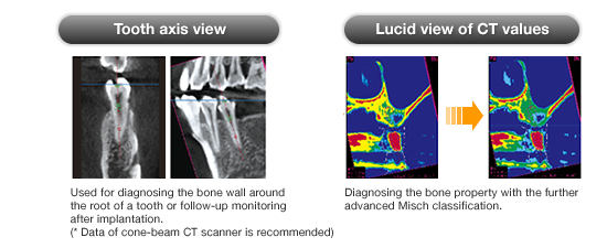 Tooth axis view/Lucid view of CT values