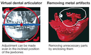 Virtual dental articulator/Removing metal artifacts